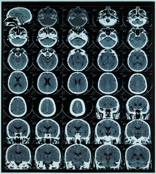 Magnetisk resonanstomografi scan av hjärnan — Stockfoto