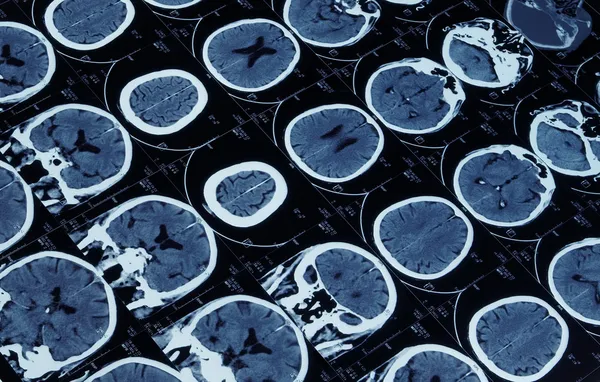Magnetycznego rezonansu mózgu — Zdjęcie stockowe