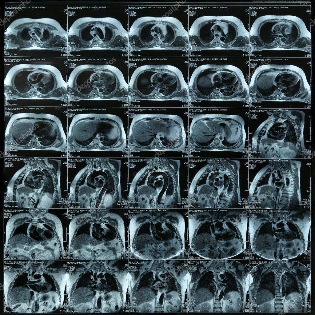 Chest MRI Stock Photo by ©beerkoff1 6335116