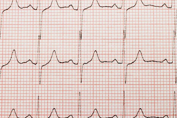 Primer plano del cardiograma — Foto de Stock
