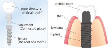Illustration of dental implant and its elements clipart