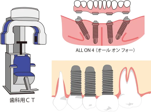 Иллюстрация зубного импланта и его элементов, КТ зубов — стоковый вектор