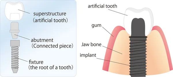Εικονογράφηση της οδοντικό εμφύτευμα και τα στοιχεία — Διανυσματικό Αρχείο