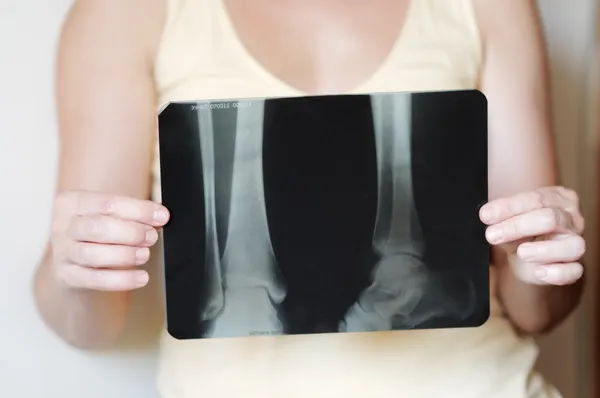 Mujer sosteniendo una imagen de rayos X — Foto de Stock
