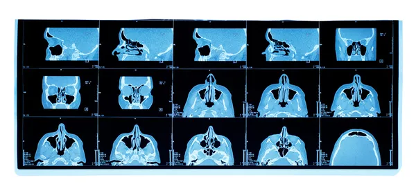 stock image Computer tomography of maxillary sinus. nasal septum deviation