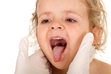 Kid face with small pox consulted by a physician clipart