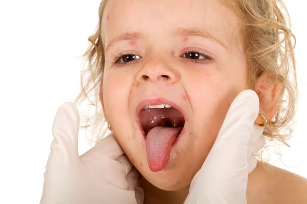 Gyerek arccal kis pox, konzultálhat az orvos — Stock Fotó