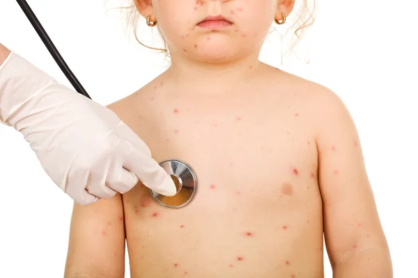 Malé dítě s fyzickou zkoušku na neštovice — Stock fotografie