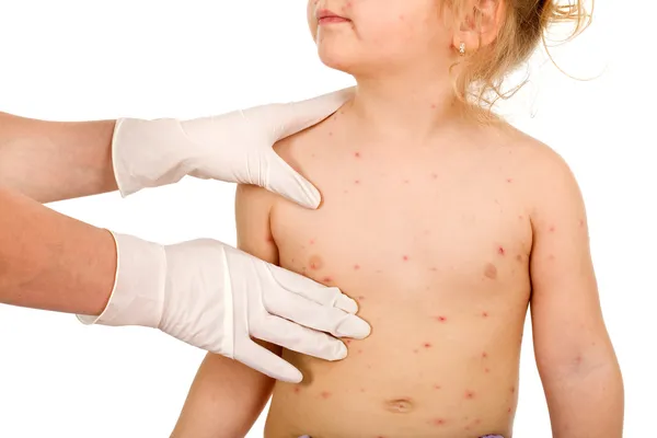 Criança com varíola pequena consultada por um médico isolado — Fotografia de Stock