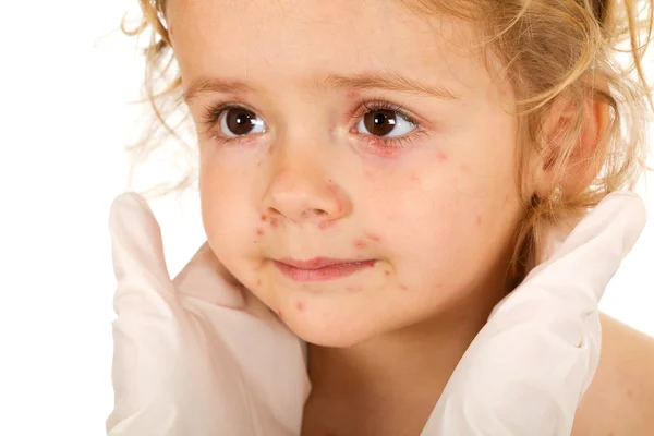 Little girl with small pox at the physician — Stock Photo, Image