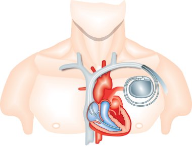 Pacemaker clipart