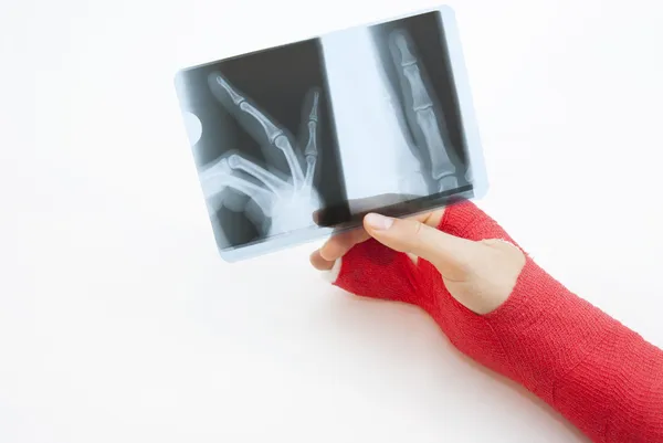 Bandage hand och röntgen print — Stockfoto
