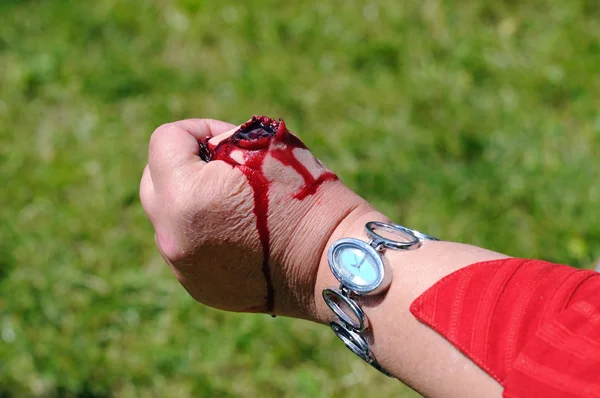 Lesioni strappato il pollice sulla mano, pratica medica — Foto Stock