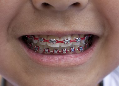 Red Braces clipart