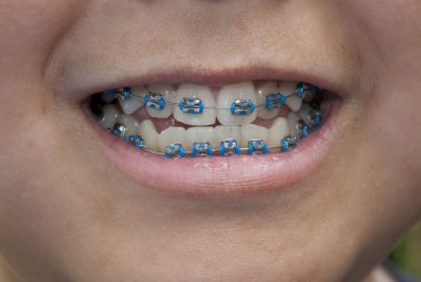 Close-up of braces clipart