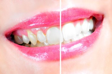 Dental Whitening clipart