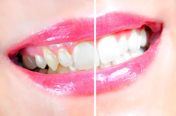 Tandläkare blekning — Stockfoto