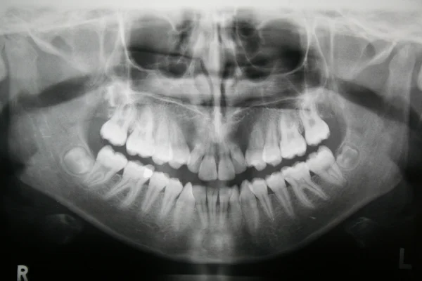 Tandheelkundige x-ray — Stockfoto